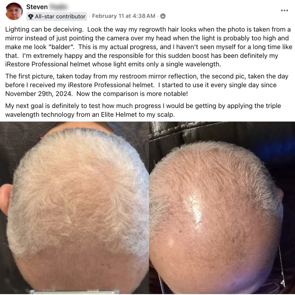 Steven's before and after hair growth story