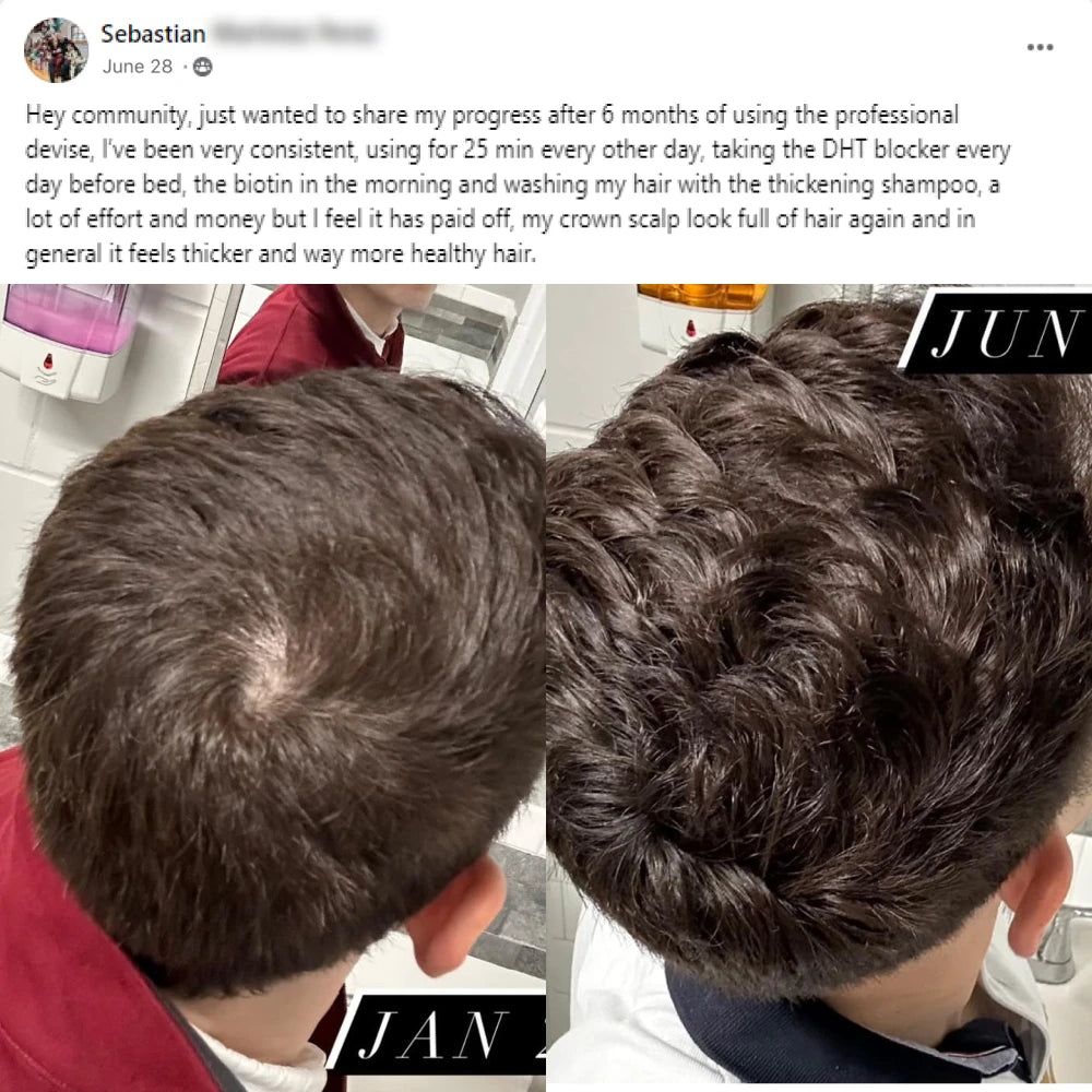 Sebastian's before and after hair growth story