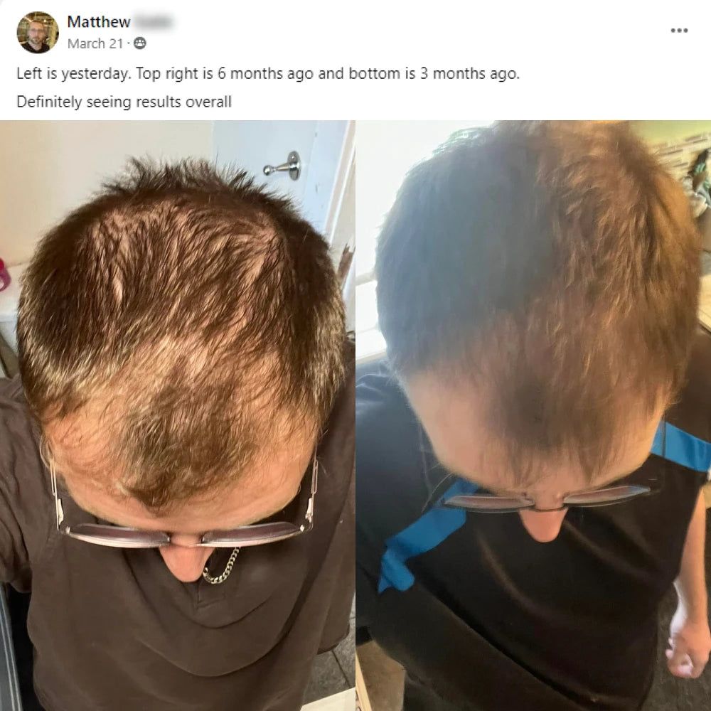 Matthew's before and after hair growth story