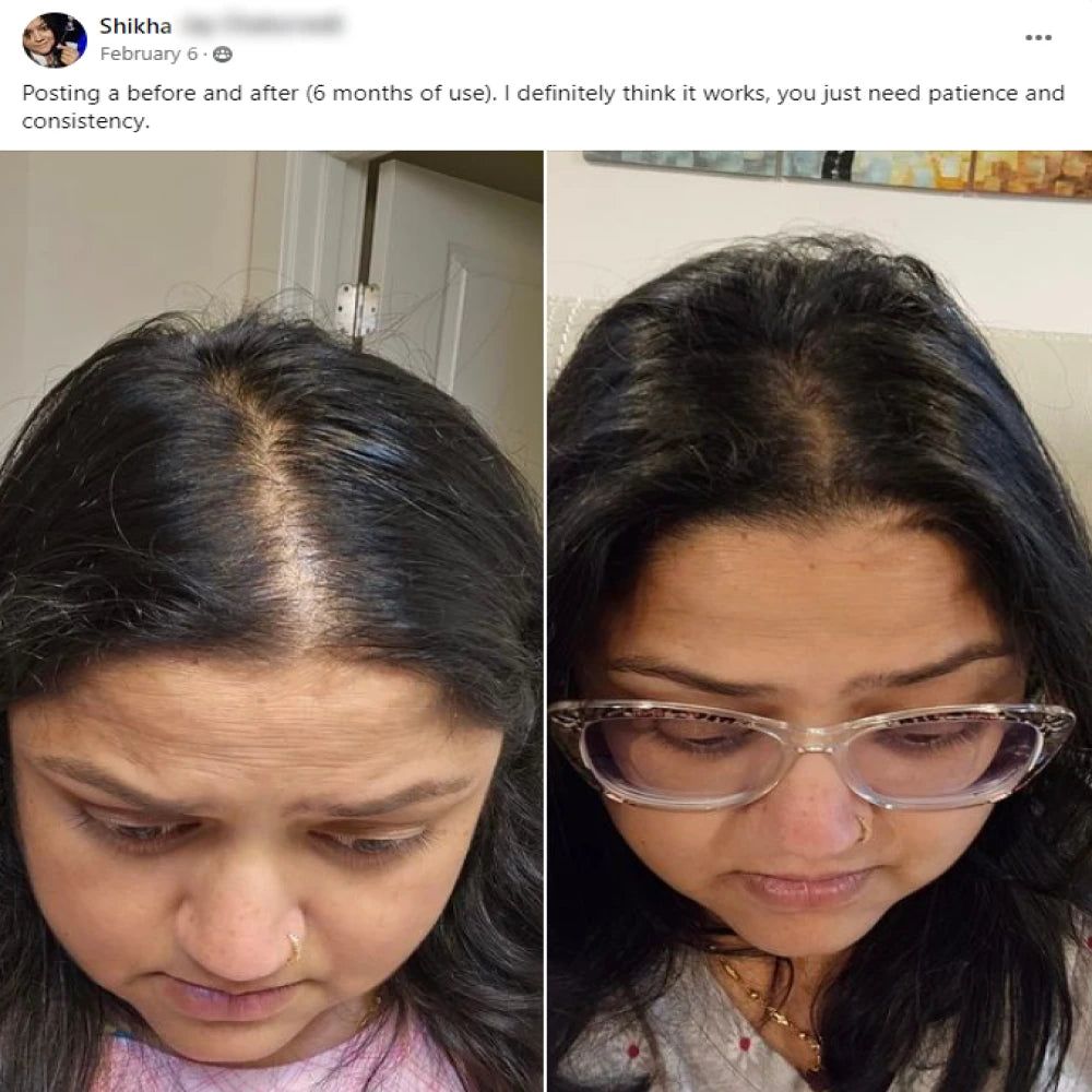 Shikha's before and after hair growth story