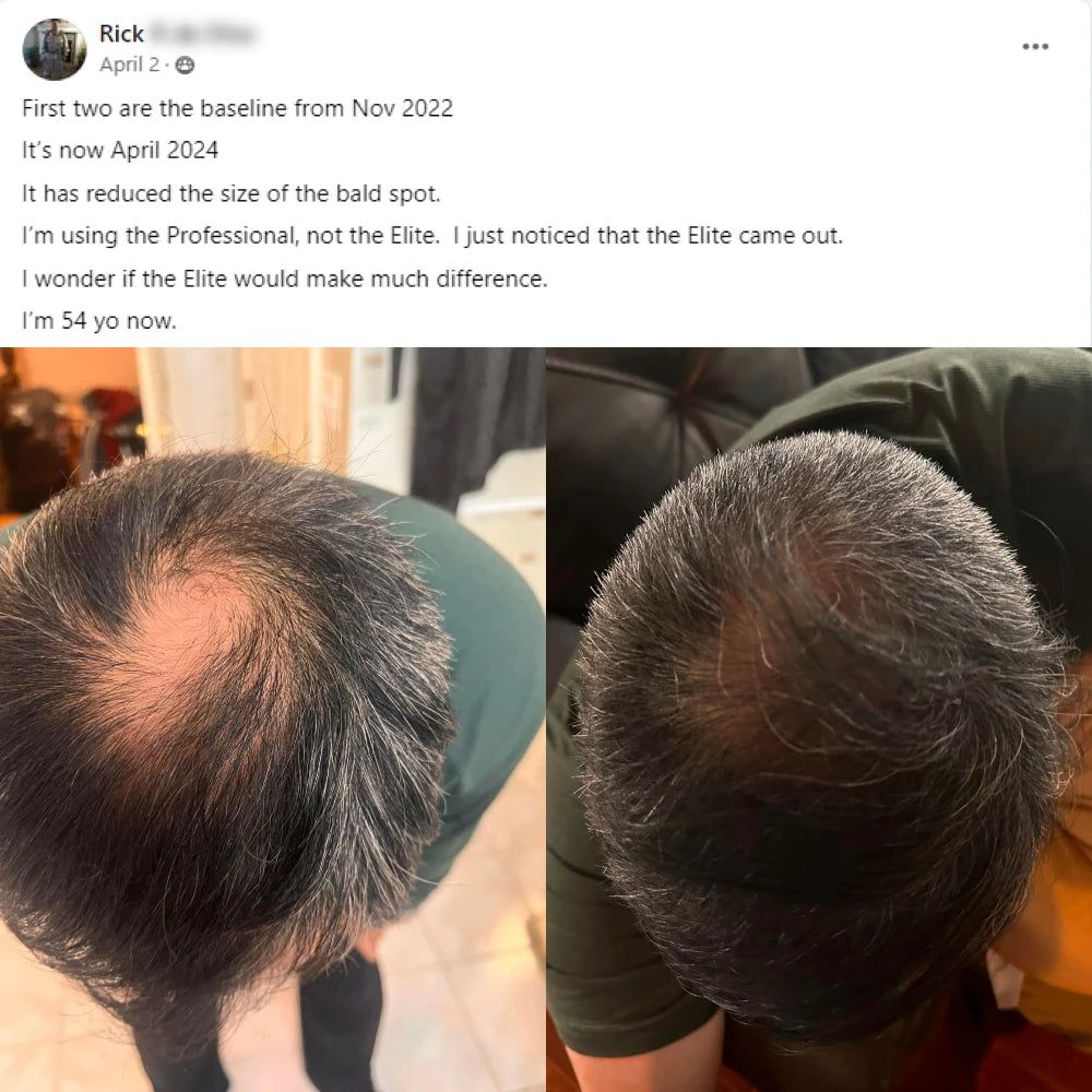 Rick's before and after hair growth story