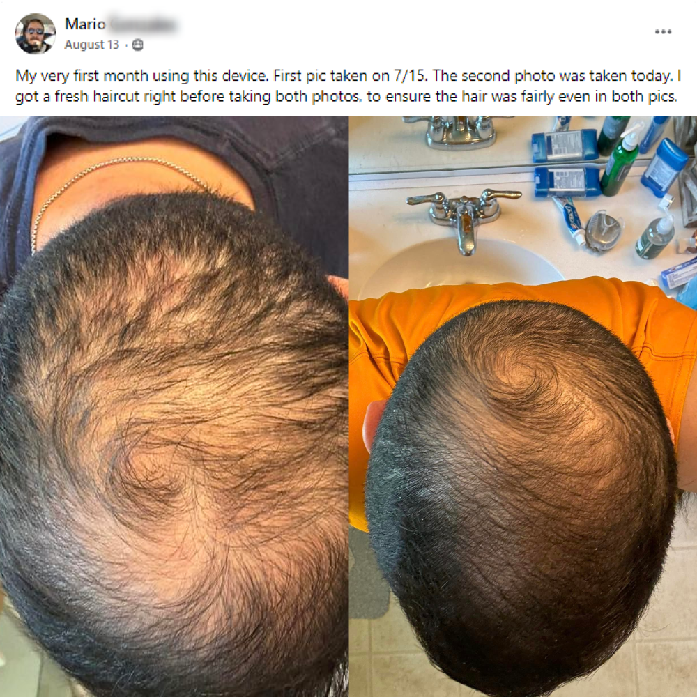 Mario's before and after hair growth story