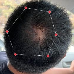 Albert's hair growth result
