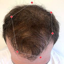 David's hair growth result