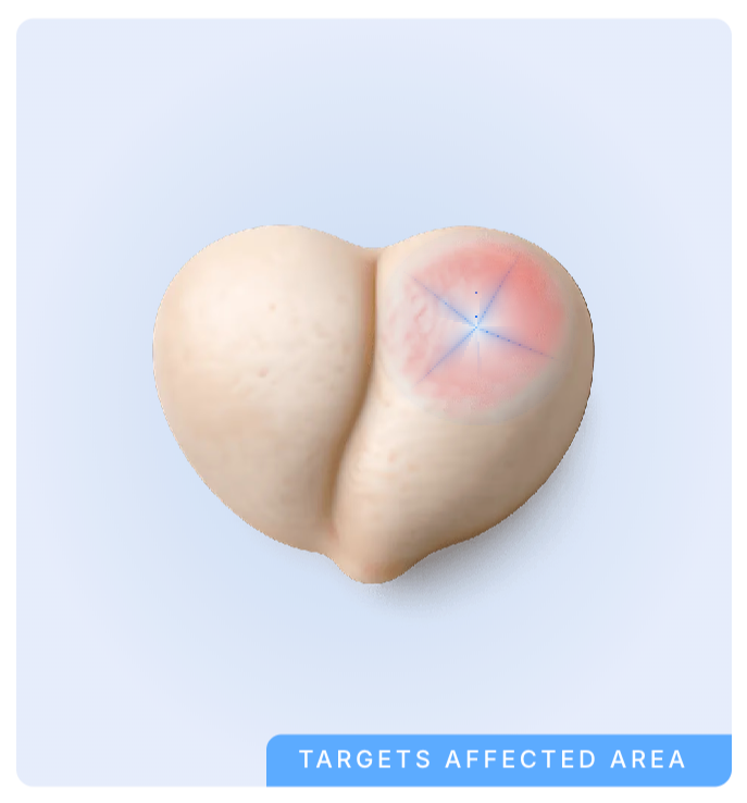 Medical illustration showing focal therapy targeting only the affected area of the prostate