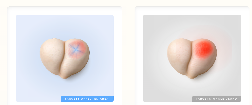 Side-by-side medical illustration comparing precise focal therapy targeting an affected area with treatment of the whole prostate gland