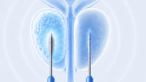 Medical illustration of cryotherapy needles freezing targeted prostate tissue