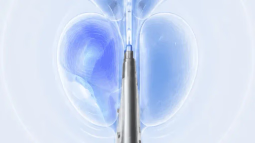 Medical illustration of the TULSA-PRO ultrasound probe